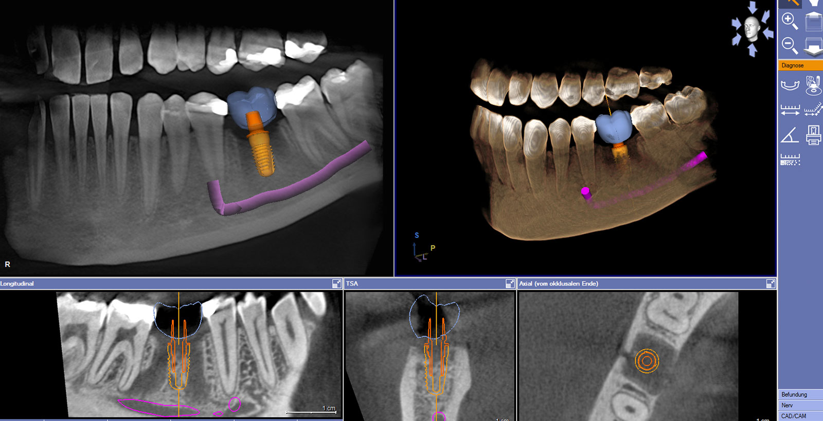 3D Implantatplanung